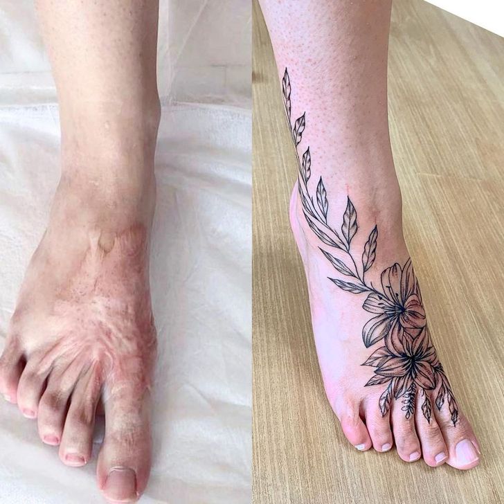 Tattoos can help you turn scars into something beautiful